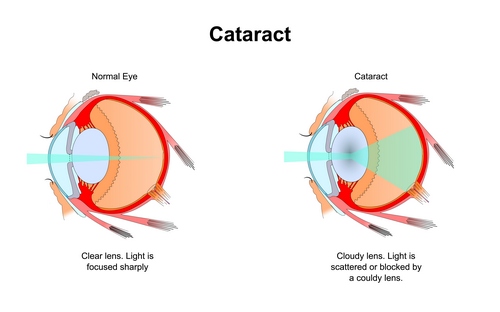 Cataracts in Dogs