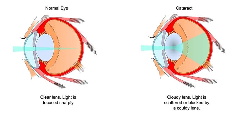 What are cataracts in dogs