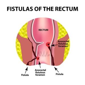 Causes of Anal Glands Issues in Dogs