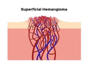 What is Hemangioma in Dogs