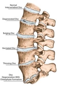 Symptoms of Slipped Disc in Dogs