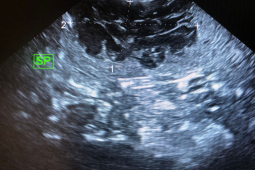 Hemangiosarcoma in dog's spleen